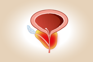 Prostatite abatterica o sindrome dolorosa pelvica cronica