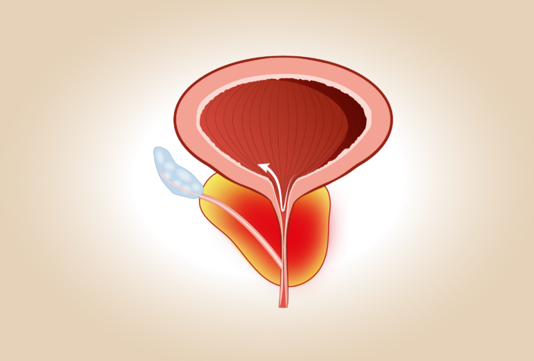 Prostatite abatterica o sindrome dolorosa pelvica cronica