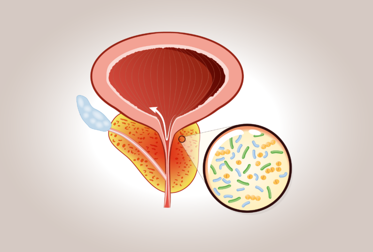 prostatite batterica