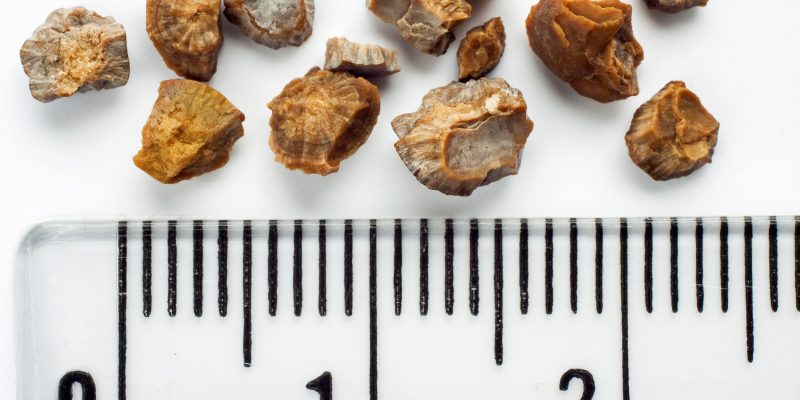 Kidney stones after ESWL intervention. Lithotripsy. Scale in centimeters