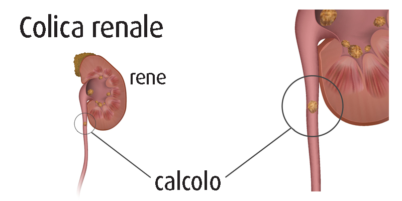 colica renale colica renale