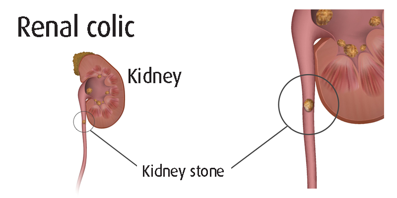 Renal colic